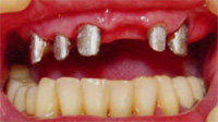 ортопедическая стоматология, лечение десен